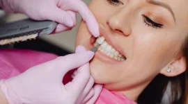 Ilustrasi pemasangan veneer gigi pada gigi seorang wanita. (Foto: Pexels)