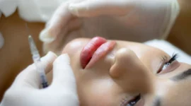 Ilustrasi filler bibir. (Foto: Pexels)